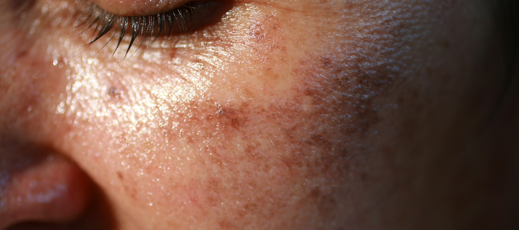 How to get rid of dark spots on black skin