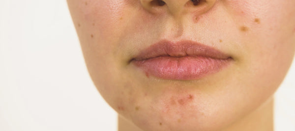 Dry skin pimples causes and treatment