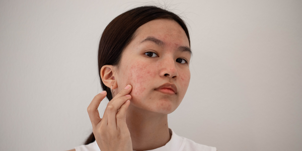 Get Complete Skin care Routine for acne prone skin