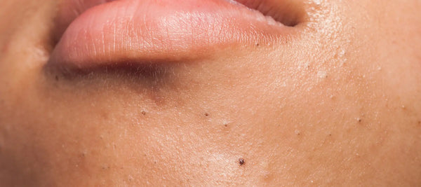 How to get rid of blackheads effectively