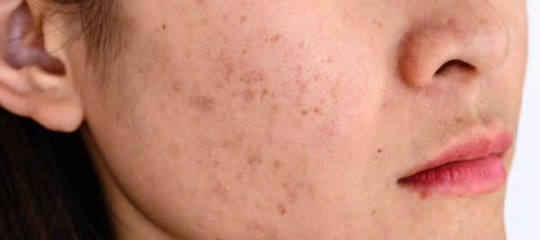 Melasma and hyperpigmentatio