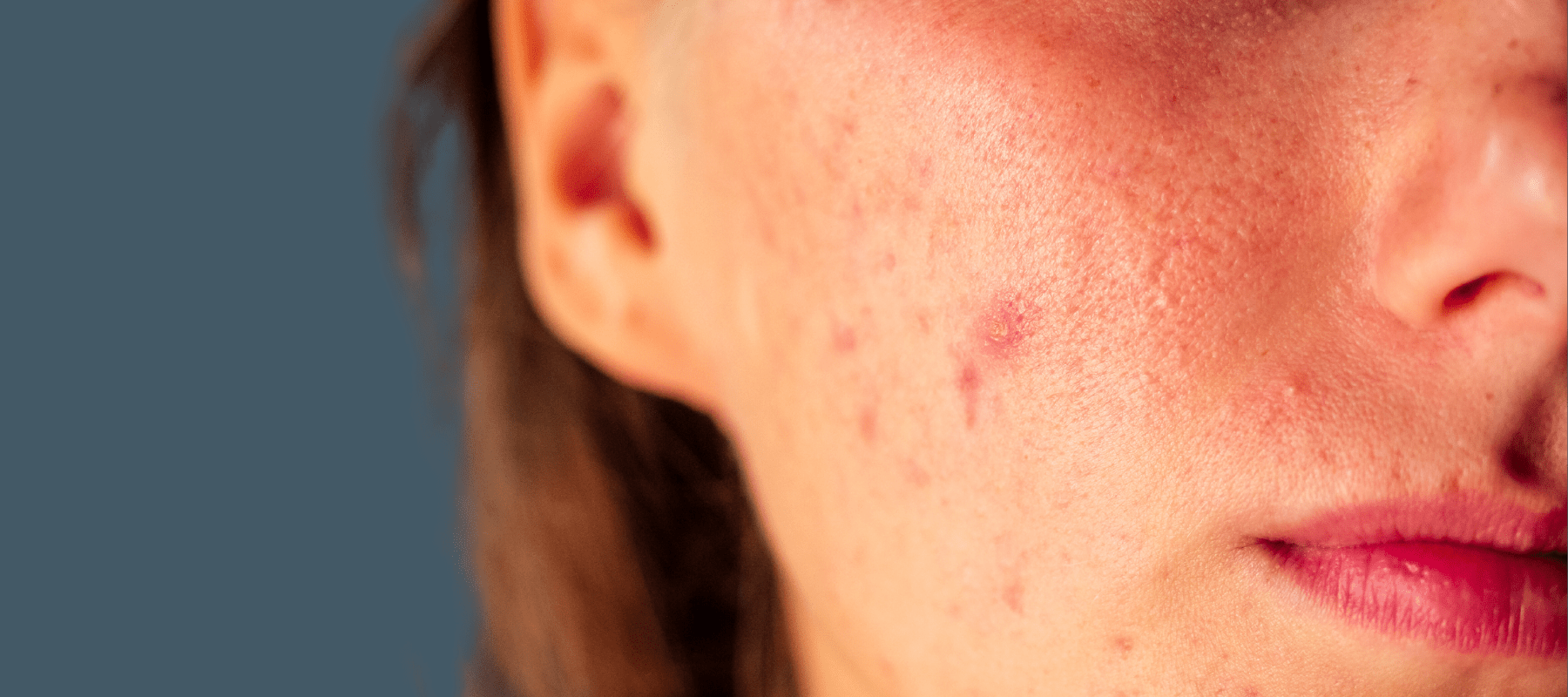 Does Salicylic Acid Remove Acne | The Pink Foundry