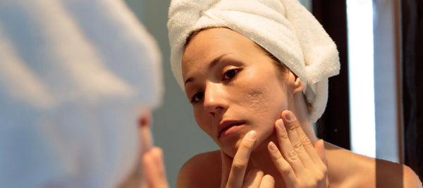 Acne scarring causes