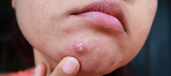 Overview of facial fungal acne, its causes, symptoms, and treatments