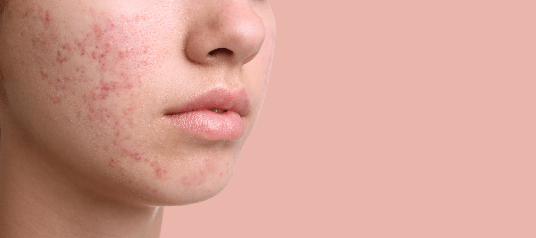 What is Acne Vulgaris: Causes, Symptoms, and Treatment - The Pink Foundry