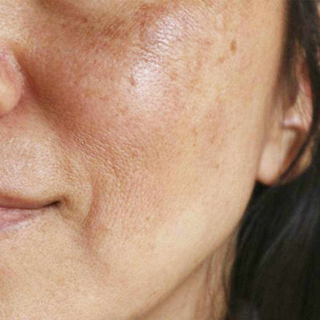 Skin Concern Dark Spots & Pigmentation - The Pink Foundry